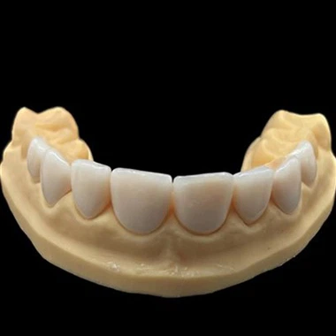 Digital Emax Veneer Esthetics