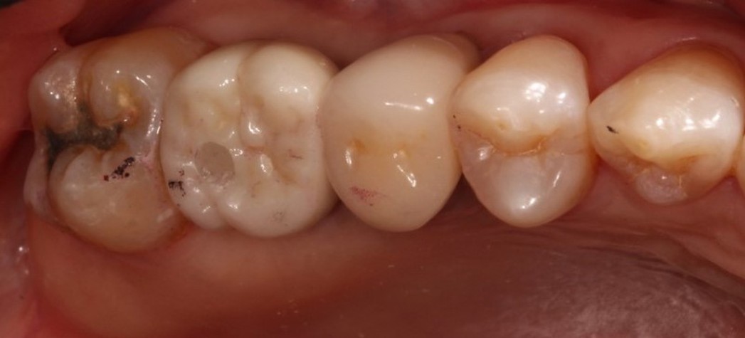 Screwed Implant Crown And Bridge Screwed Implant Crown And Bridge