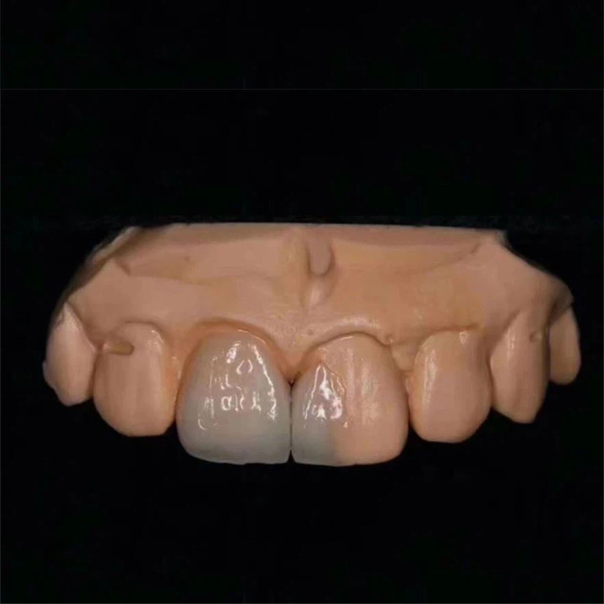 High Esthetics Dental Laminates